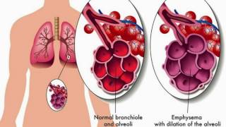 Difference Between Asthma and Bronchitis [upl. by Ahseryt]