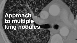 Algorithmic Approach to Multiple Lung Nodules [upl. by Odille]