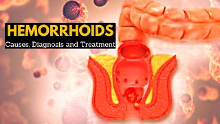 Hemorrhoids or Piles CausesSigns and symptoms Diagnosis and Treatment [upl. by Franciskus563]