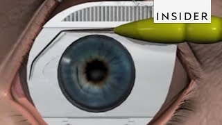 Laser Precision Restores Vision after Cataracts [upl. by Rhona821]