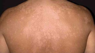 Tinea Versicolor in Young People  Pityriasis Versicolor [upl. by Ruthanne834]