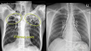 Chest x ray  Tuberculosis healed TB Inactive TB [upl. by Nahor]