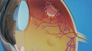 Prophylactic Laser Photocoagulation Laserpexy for Retinal Tear [upl. by Adiehsar]