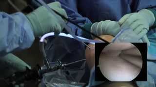 Arthroscopic Knee Surgery Meniscus Tear [upl. by Llesram]