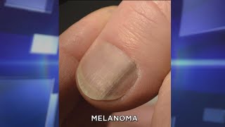 Subungual Melanoma What You Need to Know [upl. by Stafford551]