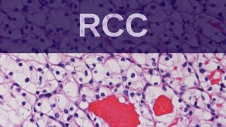 Renal cell carcinoma TypesGeneticsMorphology [upl. by Eleonore680]