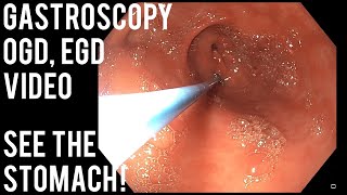 Endoscopy experience without sedation [upl. by Anotyad129]