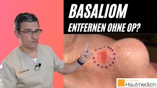 Basaliom entfernen ohne OP  Dr Kasten Hautmedizin in Mainz [upl. by Sweet465]