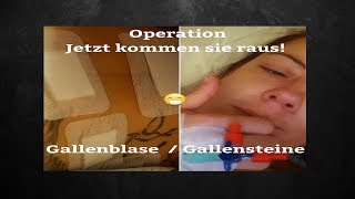 Operation Gallenblase  Gallensteine [upl. by Gen291]