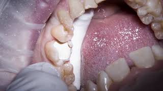 Biodentine  amalgam replacement on a large MOL cavity [upl. by Eniroc]