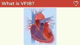 What is Ventricular Fibrillation VFIB [upl. by Anuala851]