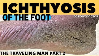 Ichthyosis of the Foot Travelin Mans Severe Skin Condition and Treatment [upl. by Horatia]