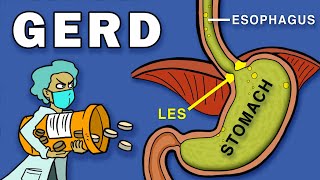 Gastroesophageal Reflux Disease GERD [upl. by Eelrebmyk]