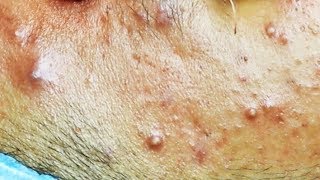 Extraction dacné kystique et pustule  cystic acne [upl. by Englis631]