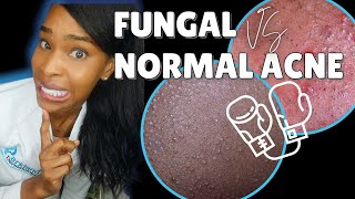 FUNGAL ACNE vs NORMAL ACNE [upl. by Donatelli]