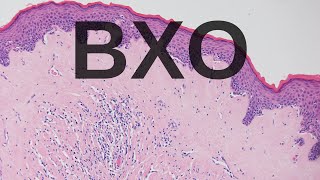 Balanitis Xerotica Obliterans BXO  Pathology mini tutorial [upl. by Ynnel]