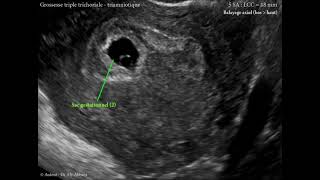 Grossesse multiple triple trichoriale et triamniotique de 5 SA LCC  18 mm [upl. by Rehtul]