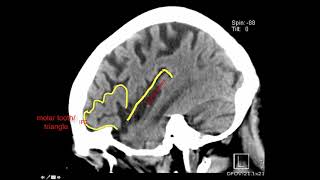 Introduction to Brain Surface Anatomy [upl. by Grew]