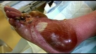 Pus Filled Blisters  Bizarre ER [upl. by Gerk]