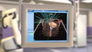 CyberKnife® Radiation Therapy What It Is amp How It Works [upl. by Sparks]