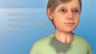 Sialorrhea Excessive Drooling  Decreasing Saliva Production [upl. by Delila]