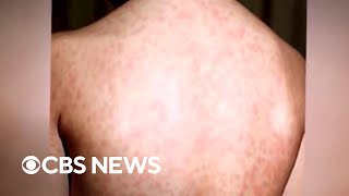 Texas measles outbreak grows [upl. by Baker973]