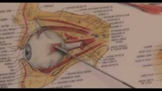 Trabeculectomy Surgery for Glaucoma Animation [upl. by Ennaear]