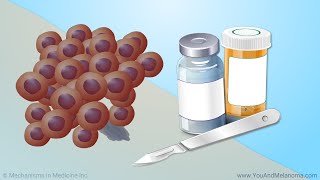 Treating Melanoma [upl. by Ykceb]