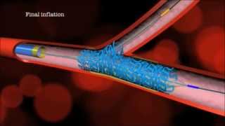 Main Branch Bifurcation Stent quotPROVISIONALquot by Advanced Bifurcation Systems [upl. by Anires]