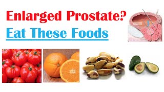 Best Foods to Eat with Enlarged Prostate  Reduce Risk of Symptoms Enlargement amp Cancer [upl. by Berthold344]