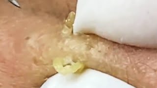 Deep blackhead extraction Cystic acne amp pimple popping 48 [upl. by Haleak]