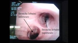 Bases anatomiques de la bronchoscopie [upl. by Aicissej902]