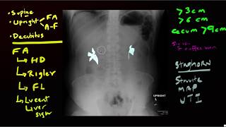 Abdominal Xrays [upl. by Nnylarej556]