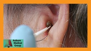 Chunky Earwax Removal  Auburn Medical Group [upl. by Ebneter]