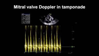 Echocardiography Essentials Detecting pericardial effusions [upl. by Ulah]