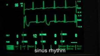 extrasystoles ventricular bigeminus [upl. by Airelav]