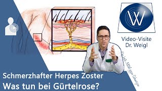 Herpes Zoster Gürtelrose durch WindpockenViren 😬 Schmerzen amp Ausschlag  Entstehung amp Therapie [upl. by North409]