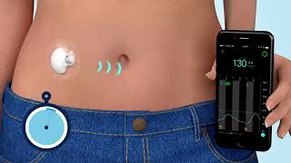 What is Continuous Glucose Monitoring CGM [upl. by Woodhouse]