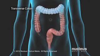 Colon Problems Diverticular Disease [upl. by Crosse]