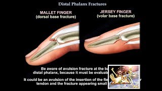 Distal Phalanx Fractures  Everything You Need To Know  Dr Nabil Ebraheim [upl. by Genesa]