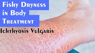 Ichthyosis Vulgaris Fishy Dryness Explained by Dr Rohit Goel [upl. by Swirsky474]