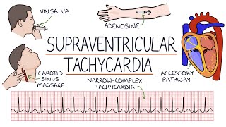 Understanding Supraventricular Tachycardia SVT [upl. by Carma960]