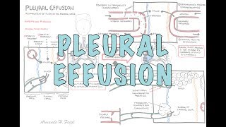 Pleural Effusion DETAILED  pathophysiology signs and symptoms treatment [upl. by Saffier]