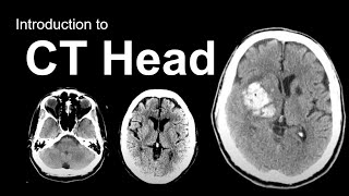 Cerebral hemisphere Sulci and Gyri Neuroanatomy [upl. by Gaston]