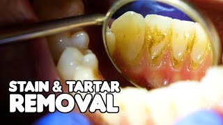 Dental Cleaning EXPLAINED  Stain amp Tartar Removal [upl. by Gambell]