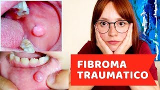 Fibroma Traumático [upl. by Rats613]