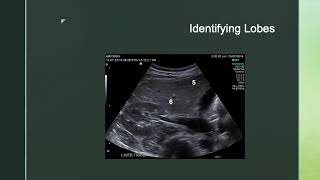 Ultrasound and Liver Segments [upl. by Jeanelle]