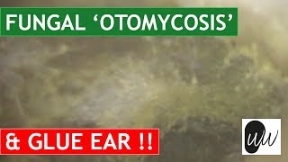 MOST CHALLENGING Otomycosis Fungal Ear Infection Removal from Ear with Glue Ear  370 [upl. by Gad]