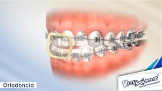 Corrección de mordida y espacios dentales quotOrtodonciaquot [upl. by Aseret]