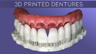 Why Digital Dentures Make Great Provisionals amp How To Characterize Digital Dentures [upl. by Nauqal]